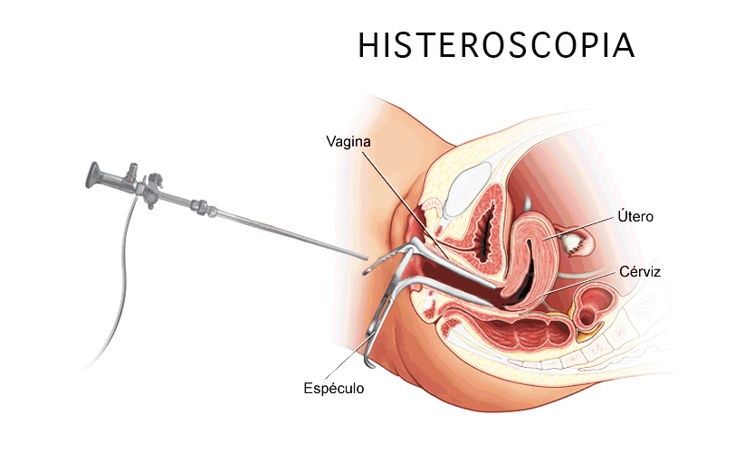 gif animado que explica la tecnica de la histeroscopia y biopsia endometrial para obtener una muestra de tejido del endometrio