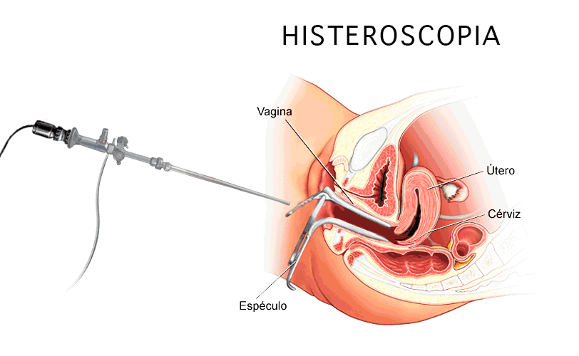 Infografia histeroscopia