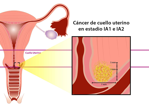 cancer cuello uterino