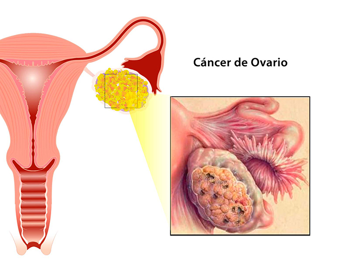 cancer ovario