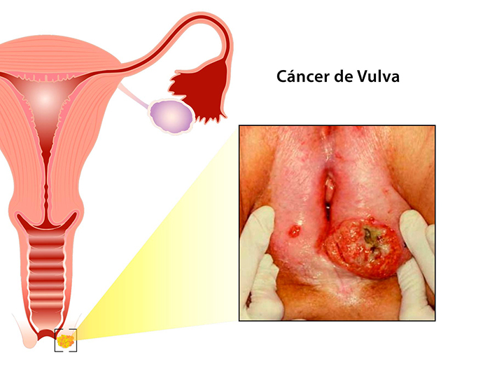 cancer vulva